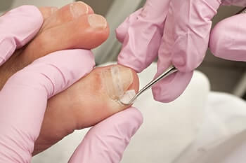 Ingrown Toenails Treatment  Foot Doctor Nashville, TN 37203