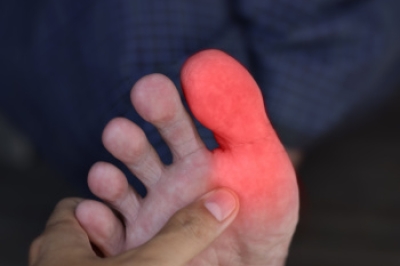 What Are Hallux Valgus and Hallux Rigidus?