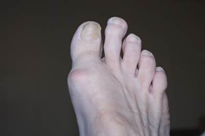 What Is Morton's Toe?