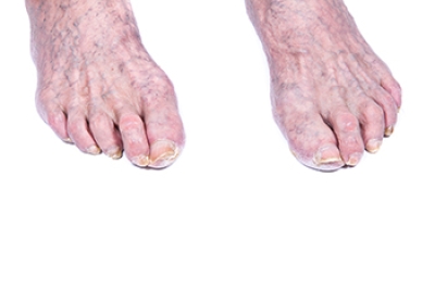 Natural Changes in Aging Feet
